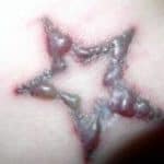 Tattoo lasern Balingen