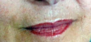 Lippenfältchen entfernen Botox Rottweil 