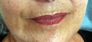 Lippenfältchen entfernen Rottweil 