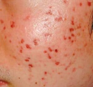 Akne und Neurodermitis geplagte Haut Villingen Schwenningen