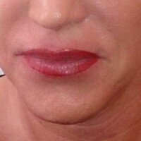 Korrektur der Lippe