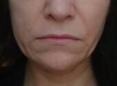 Fehlendes seitliches Volumen und sichtbare Nasolabialfalten Aknebehandlung Kosmetikstudio Rottweil und Oberndorf Botox