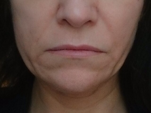 Aknebehandlung Kosmetikstudio Rottweil und Oberndorf Botox