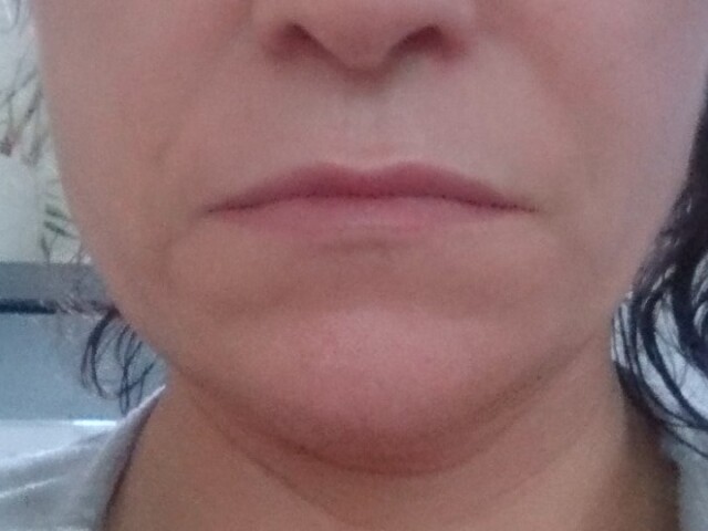 Microneedling Kosmetik Rottweil Aknebehandlung
