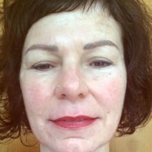 Lippenvergößerung Foto nachher Rottweil