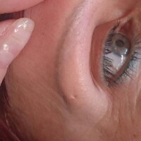 Tattoo laser Tattoo entfernen Bad Dürrheim Donaueschingen Albstadt Ebingen