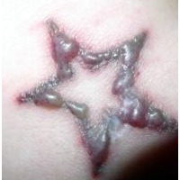 tattoo lasern Balingen Oberndorf am neckar