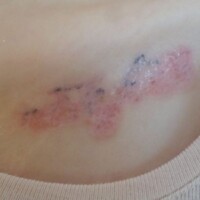 Tattoo Schrift entfernt Oberndorf am neckar und Balingen Albstadt-Ebingen
