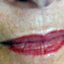 gegen Lippenfältchen mit dermaroller Rottweil