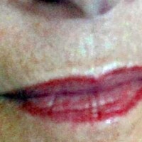 gegen Lippenfältchen mit dermaroller Rottweil