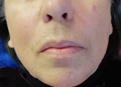 Behandlung kosmetische Frequenzwellen vorher (Microneedling 3 Wochen davor)